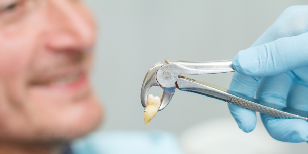 tooth extraction
