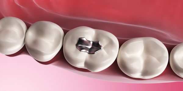 tooth filling