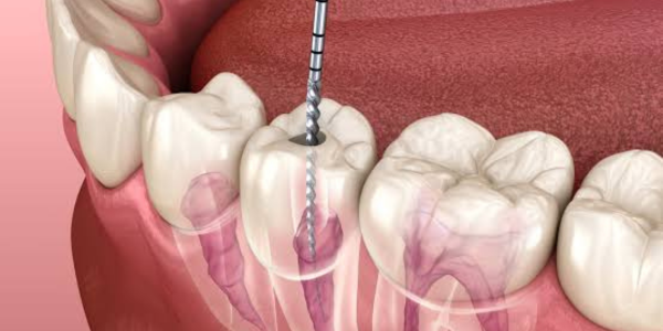 Root canal treatment