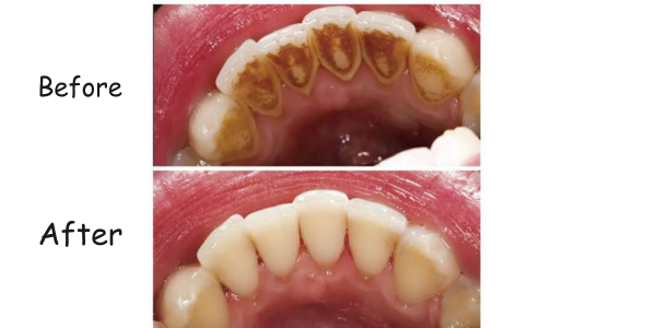 Teeth cleaning