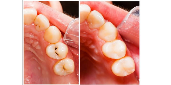 Tooth filling