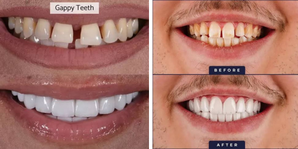 veneer